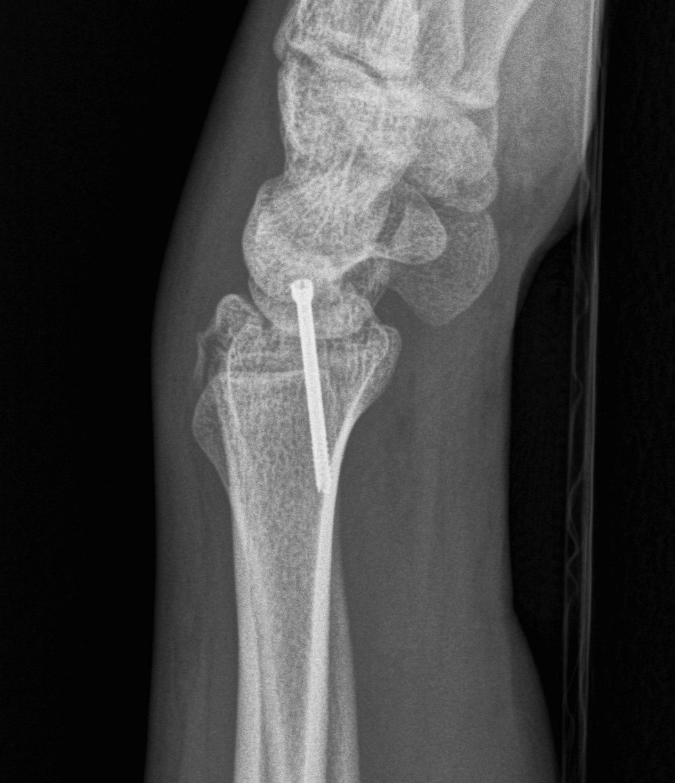 Radial Styloid ORIF Lateral